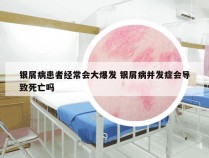 银屑病患者经常会大爆发 银屑病并发症会导致死亡吗