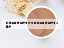 银屑病皮肤病理多少钱 银屑病皮肤病理多少钱啊