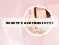 银屑病血管形态 银屑病皮肤病镜下血管图片