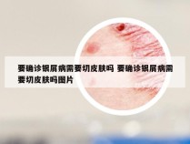 要确诊银屑病需要切皮肤吗 要确诊银屑病需要切皮肤吗图片