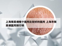 上海银屑病哪个医院比较好的医院 上海市银屑病医院排行榜