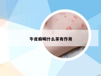 牛皮癣喝什么茶有作用
