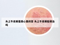 头上牛皮癣是我心里的苦 头上牛皮癣能根治吗