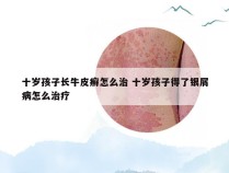 十岁孩子长牛皮癣怎么治 十岁孩子得了银屑病怎么治疗