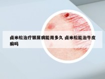 卤米松治疗银屑病能用多久 卤米松能治牛皮癣吗