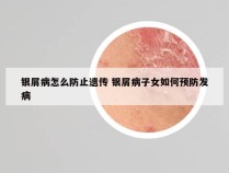 银屑病怎么防止遗传 银屑病子女如何预防发病