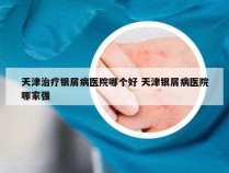 天津治疗银屑病医院哪个好 天津银屑病医院哪家强