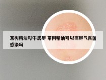 茶树精油对牛皮癣 茶树精油可以擦脚气真菌感染吗