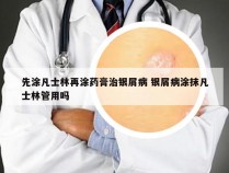 先涂凡士林再涂药膏治银屑病 银屑病涂抹凡士林管用吗