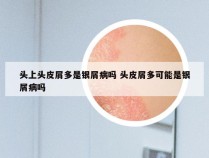 头上头皮屑多是银屑病吗 头皮屑多可能是银屑病吗