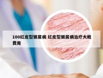 100红皮型银屑病 红皮型银屑病治疗大概费用