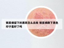 银屑病留下的黑斑怎么去除 银屑病剩下黑色印子是好了吗