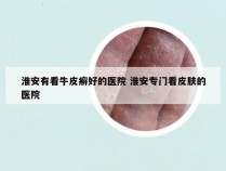 淮安有看牛皮癣好的医院 淮安专门看皮肤的医院