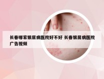 长春哪家银屑病医院好不好 长春银屑病医院广告视频