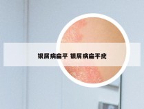 银屑病扁平 银屑病扁平疣