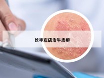 长丰左店治牛皮癣