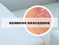 银屑病脚肿疼吗 银屑病引起腿脚肿胀