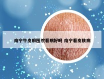南宁牛皮癣医院看病好吗 南宁看皮肤病