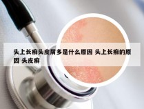 头上长癣头皮屑多是什么原因 头上长癣的原因 头皮癣