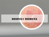 银屑病冬瓜汁 银屑病吃冬瓜