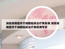 湖南湘雅医院干细胞临床治疗银屑病 湖南湘雅医院干细胞临床治疗银屑病专家