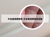 牛皮癣调理视频 牛皮癣调理视频讲解