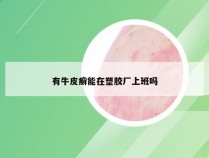 有牛皮癣能在塑胶厂上班吗