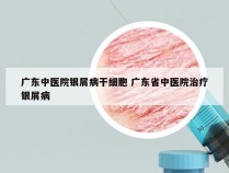 广东中医院银屑病干细胞 广东省中医院治疗银屑病