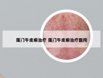 厦门牛皮癣治疗 厦门牛皮癣治疗医院