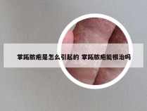 掌跖脓疱是怎么引起的 掌跖脓疱能根治吗