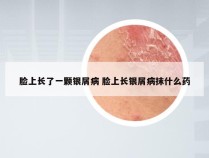 脸上长了一颗银屑病 脸上长银屑病抹什么药