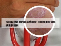 沈阳口碑最好的银屑病医院 沈阳哪里有银屑病生物制剂