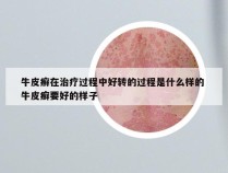 牛皮癣在治疗过程中好转的过程是什么样的 牛皮癣要好的样子