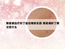 银屑病治疗好了能吃哪些东西 银屑病好了要注意什么