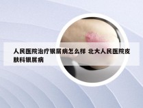 人民医院治疗银屑病怎么样 北大人民医院皮肤科银屑病