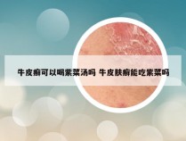 牛皮癣可以喝紫菜汤吗 牛皮肤癣能吃紫菜吗