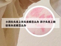 小孩头头皮上长头皮癣怎么办 孩子头皮上貌似有头皮癣怎么办