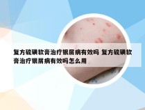 复方硫磺软膏治疗银屑病有效吗 复方硫磺软膏治疗银屑病有效吗怎么用