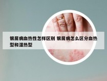 银屑病血热性怎样区别 银屑病怎么区分血热型和湿热型
