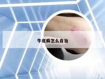 牛皮癣怎么自治