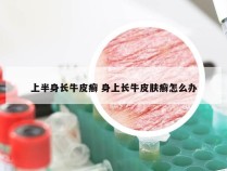 上半身长牛皮癣 身上长牛皮肤癣怎么办