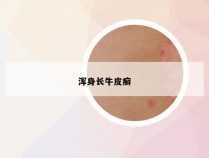 浑身长牛皮癣