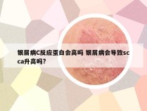 银屑病C反应蛋白会高吗 银屑病会导致scca升高吗?