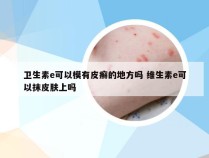 卫生素e可以模有皮癣的地方吗 维生素e可以抹皮肤上吗