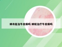 蝉衣能治牛皮癣吗 蝉蜕治疗牛皮癣吗