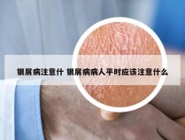 银屑病注意什 银屑病病人平时应该注意什么