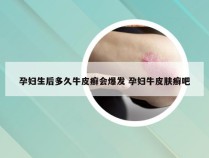 孕妇生后多久牛皮癣会爆发 孕妇牛皮肤癣吧