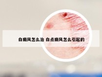 白癜风怎么治 白点癫风怎么引起的