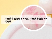 牛皮癣会遗传给下一代么 牛皮皮癣遗传下一代几率
