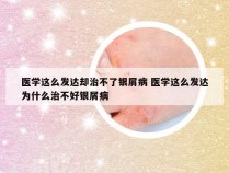 医学这么发达却治不了银屑病 医学这么发达为什么治不好银屑病